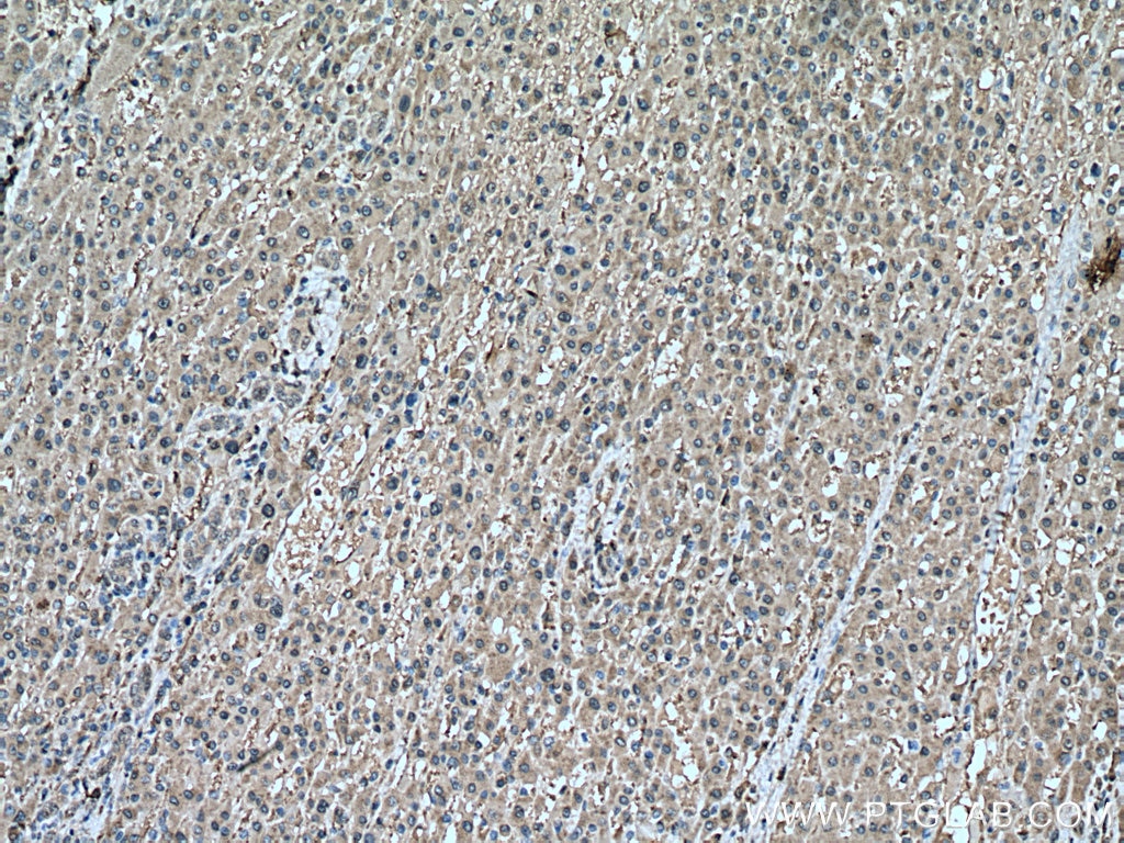 IHC staining of human liver cancer using 66820-1-Ig