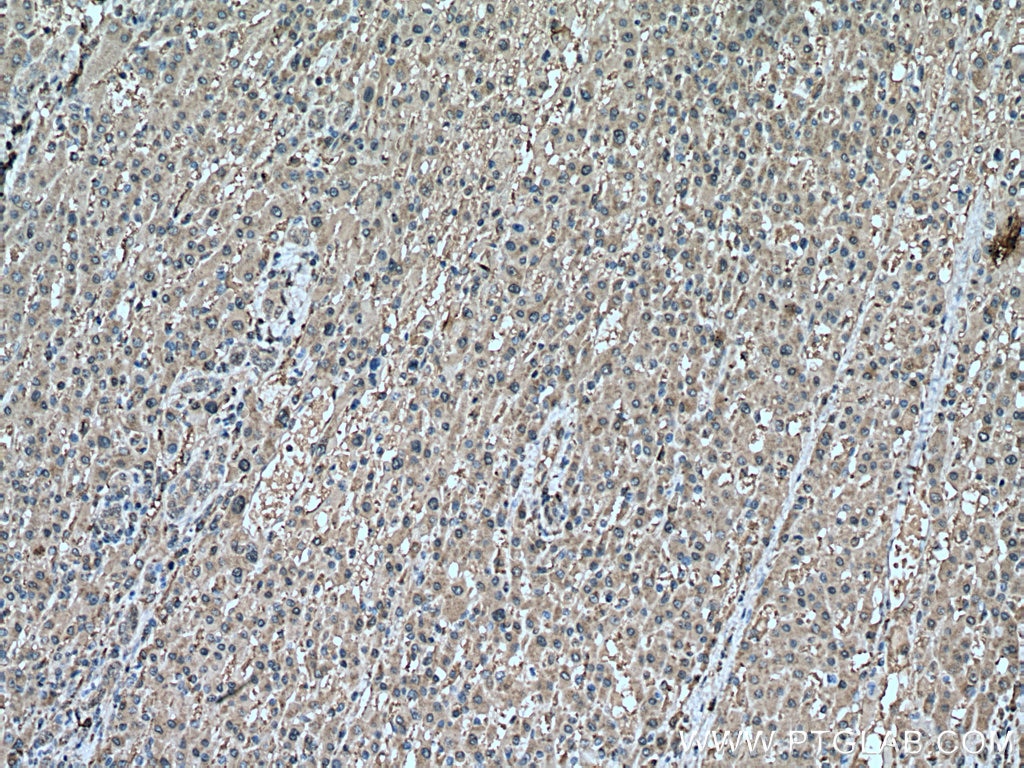 Immunohistochemistry (IHC) staining of human liver cancer tissue using PRDX1 Monoclonal antibody (66820-1-Ig)