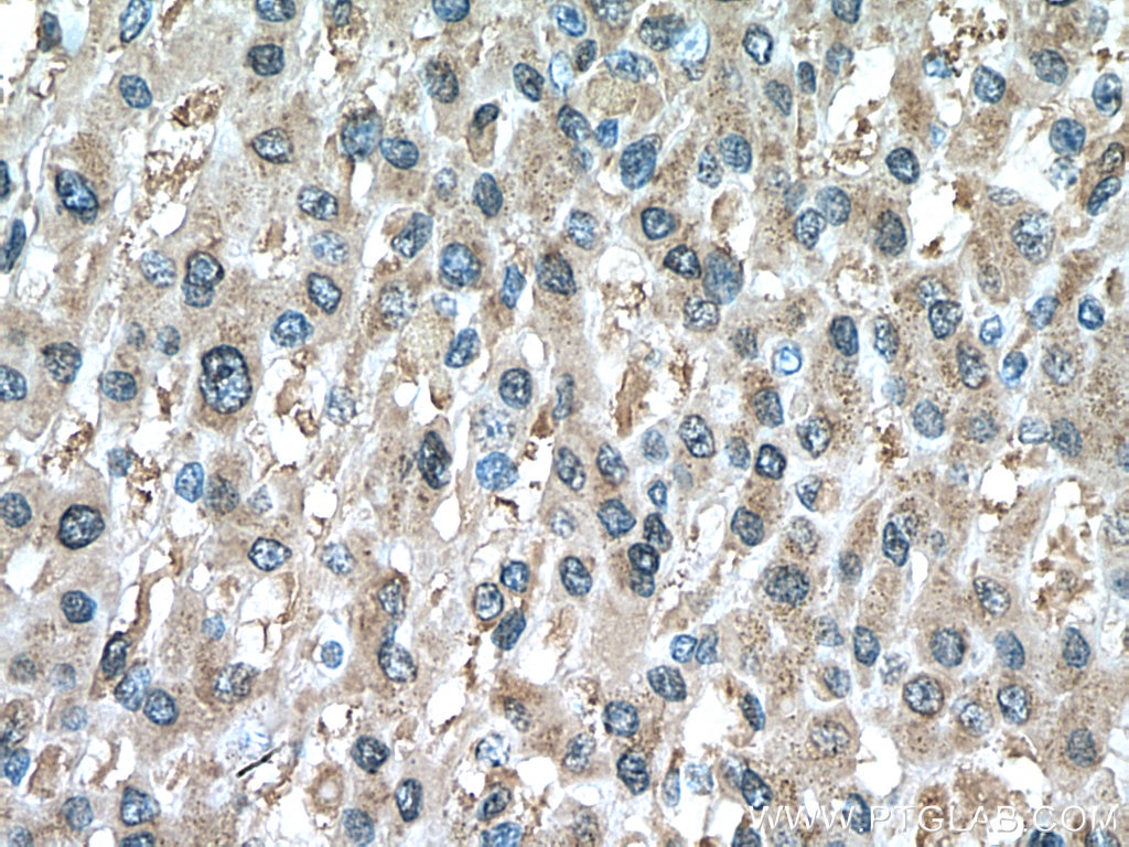 Immunohistochemistry (IHC) staining of human liver cancer tissue using PRDX1 Monoclonal antibody (66820-1-Ig)