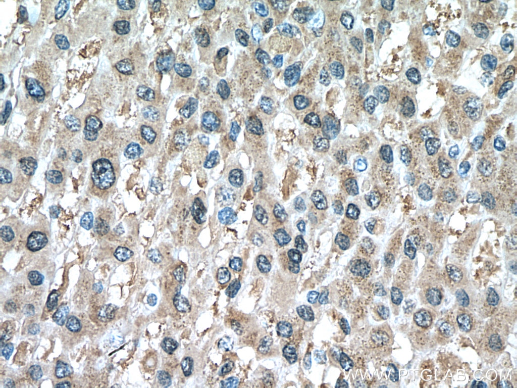 Immunohistochemistry (IHC) staining of human liver cancer tissue using PRDX1 Monoclonal antibody (66820-1-Ig)