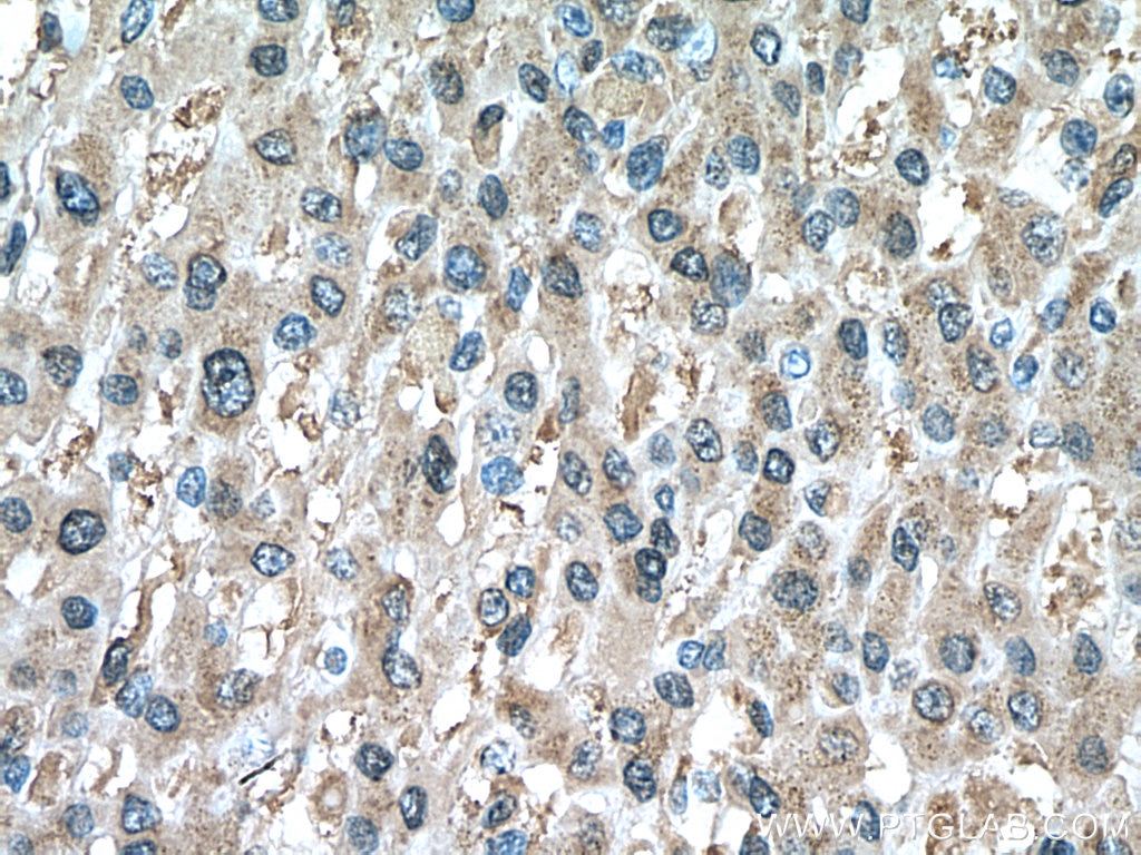 IHC staining of human liver cancer using 66820-1-Ig