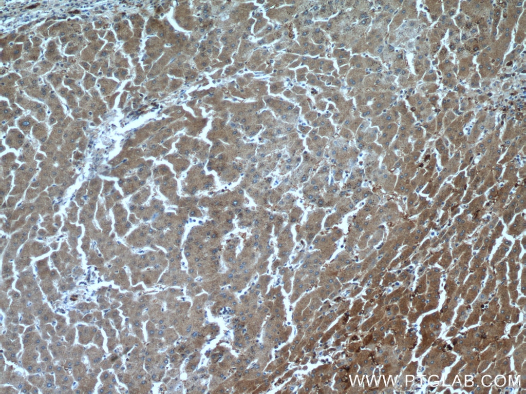 Immunohistochemistry (IHC) staining of human hepatocirrhosis tissue using peroxiredoxin 2 Polyclonal antibody (10545-2-AP)