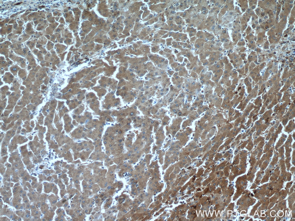 IHC staining of human hepatocirrhosis using 10545-2-AP