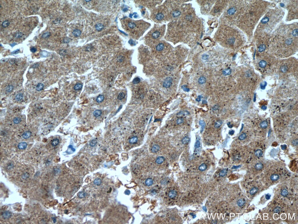 IHC staining of human hepatocirrhosis using 10545-2-AP