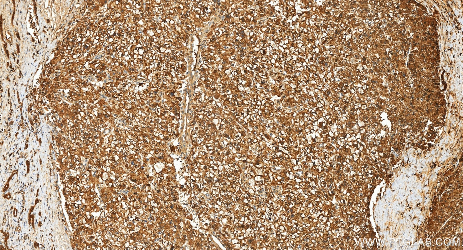 IHC staining of human liver cancer using 60202-1-Ig Immunohistochemistry (IHC) staining of human liver cancer tissue using Peroxiredoxin 2 Monoclonal antibody (60202-1-Ig)