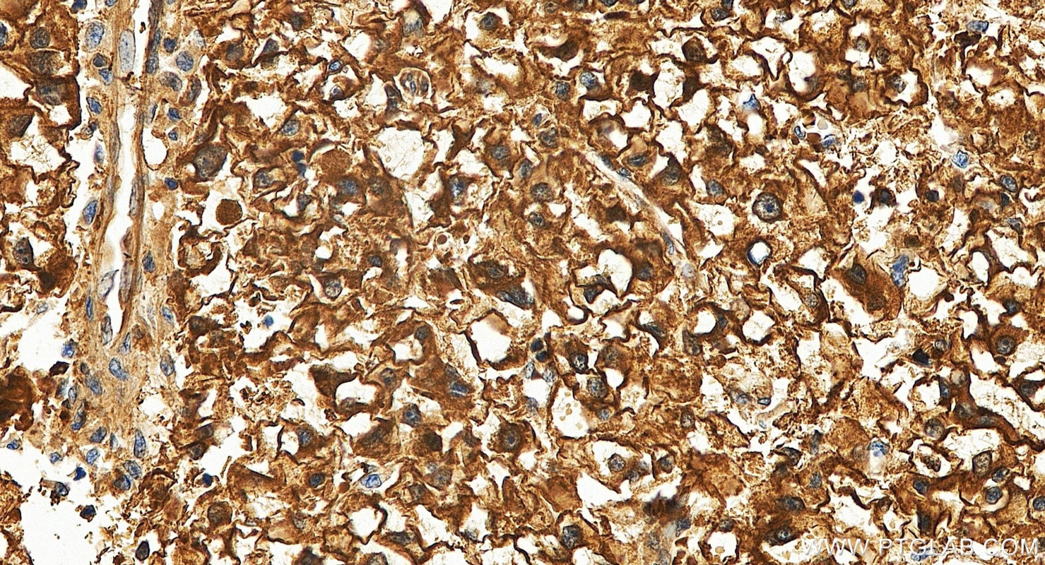 IHC staining of human liver cancer using 60202-1-Ig Immunohistochemistry (IHC) staining of human liver cancer tissue using Peroxiredoxin 2 Monoclonal antibody (60202-1-Ig)