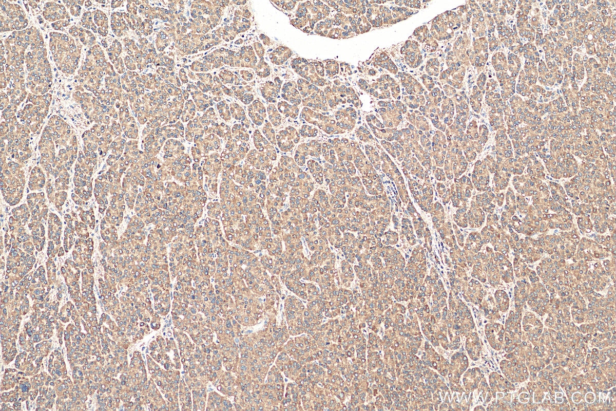 Immunohistochemistry (IHC) staining of human liver cancer tissue using PRDX3 Polyclonal antibody (55087-1-AP)