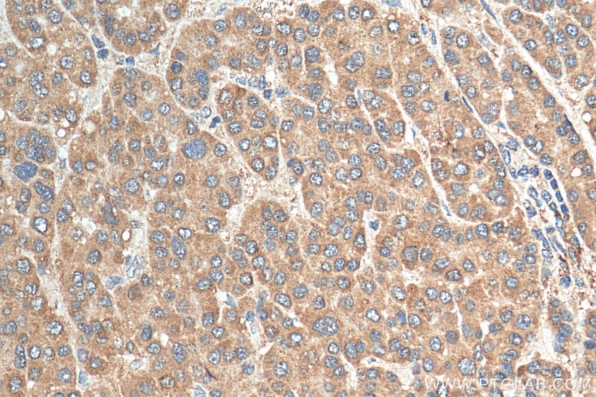 Immunohistochemistry (IHC) staining of human liver cancer tissue using PRDX3 Polyclonal antibody (55087-1-AP)