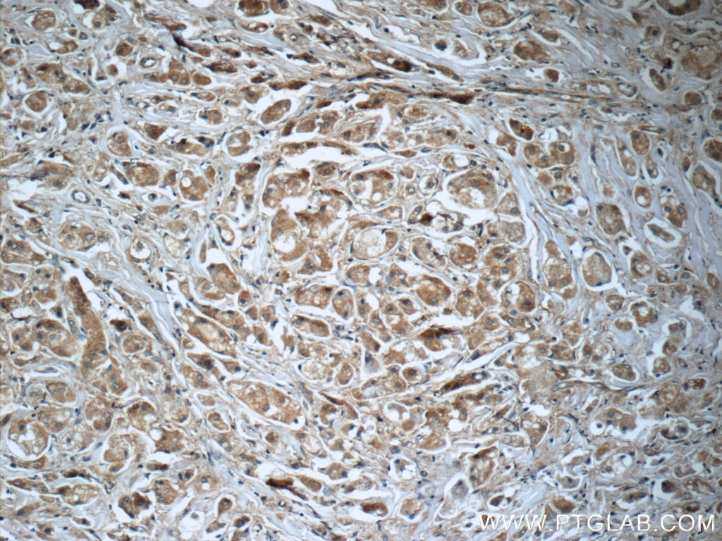 Immunohistochemistry (IHC) staining of human breast cancer tissue using PRDX3 Polyclonal antibody (55087-1-AP)