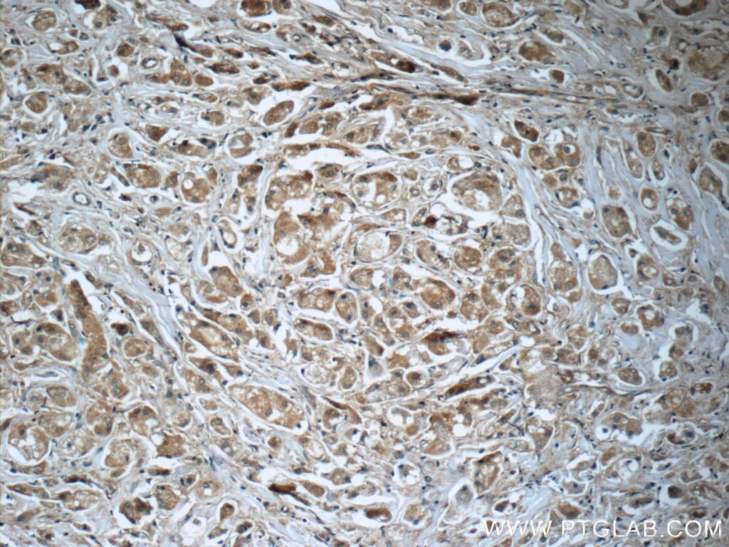 Immunohistochemistry (IHC) staining of human breast cancer tissue using PRDX3 Polyclonal antibody (55087-1-AP)