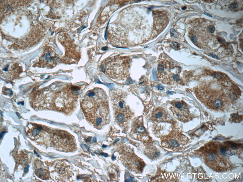 Immunohistochemistry (IHC) staining of human breast cancer tissue using PRDX3 Polyclonal antibody (55087-1-AP)