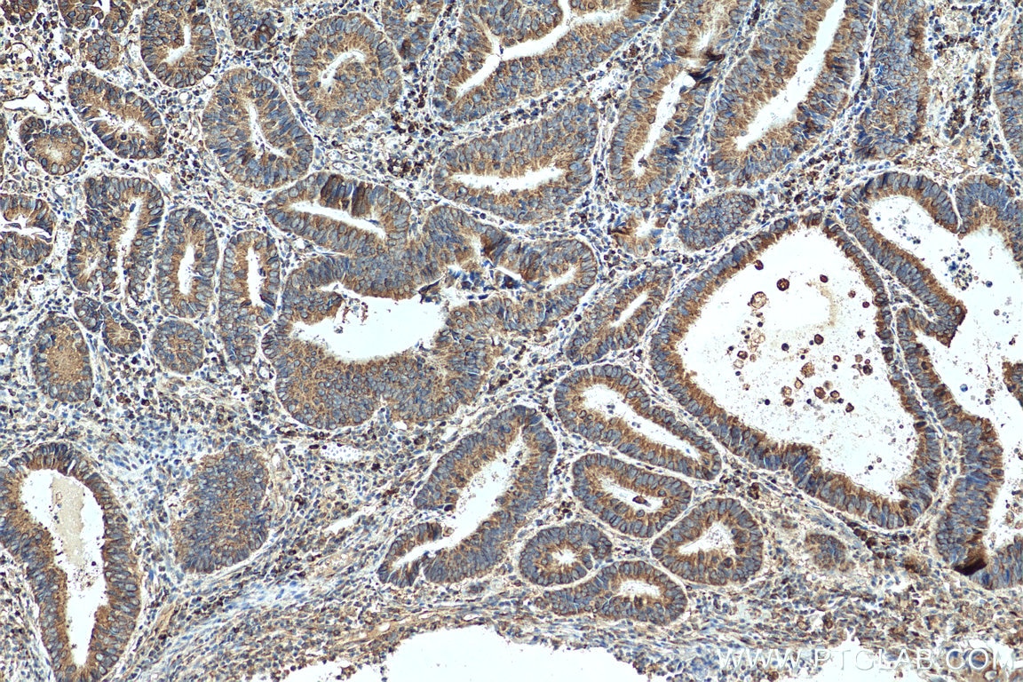 Immunohistochemistry (IHC) staining of human colon cancer tissue using PRDX4 Polyclonal antibody (10703-1-AP)