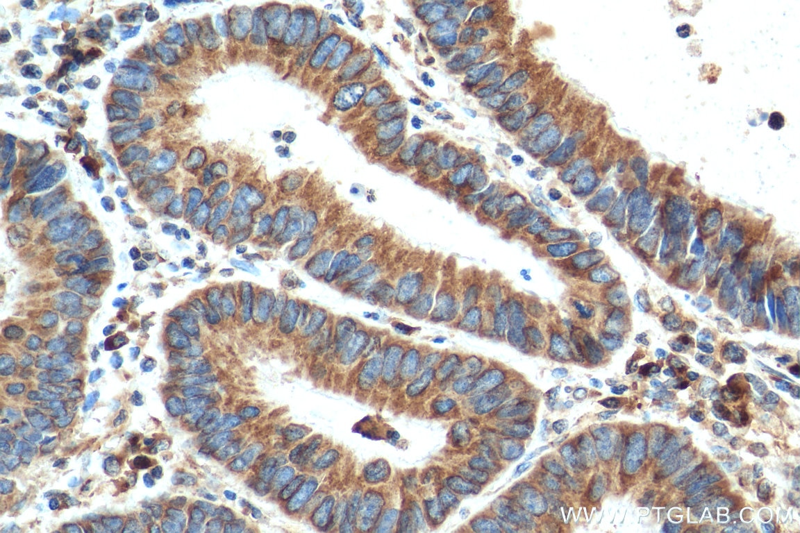 Immunohistochemistry (IHC) staining of human colon cancer tissue using PRDX4 Polyclonal antibody (10703-1-AP)