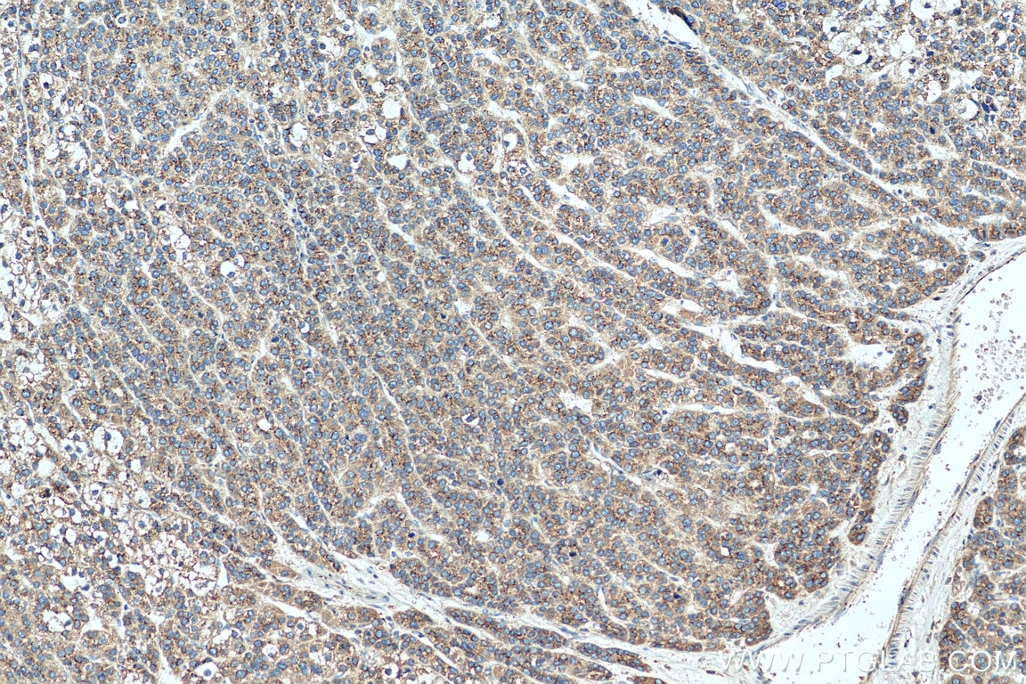 Immunohistochemistry (IHC) staining of human liver cancer tissue using PRDX4 Polyclonal antibody (10703-1-AP)