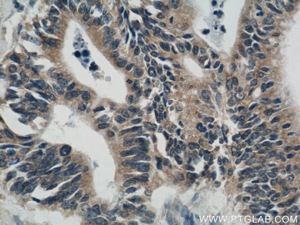 Immunohistochemistry (IHC) staining of human pancreas cancer tissue using PRDX4 Polyclonal antibody (10703-1-AP)