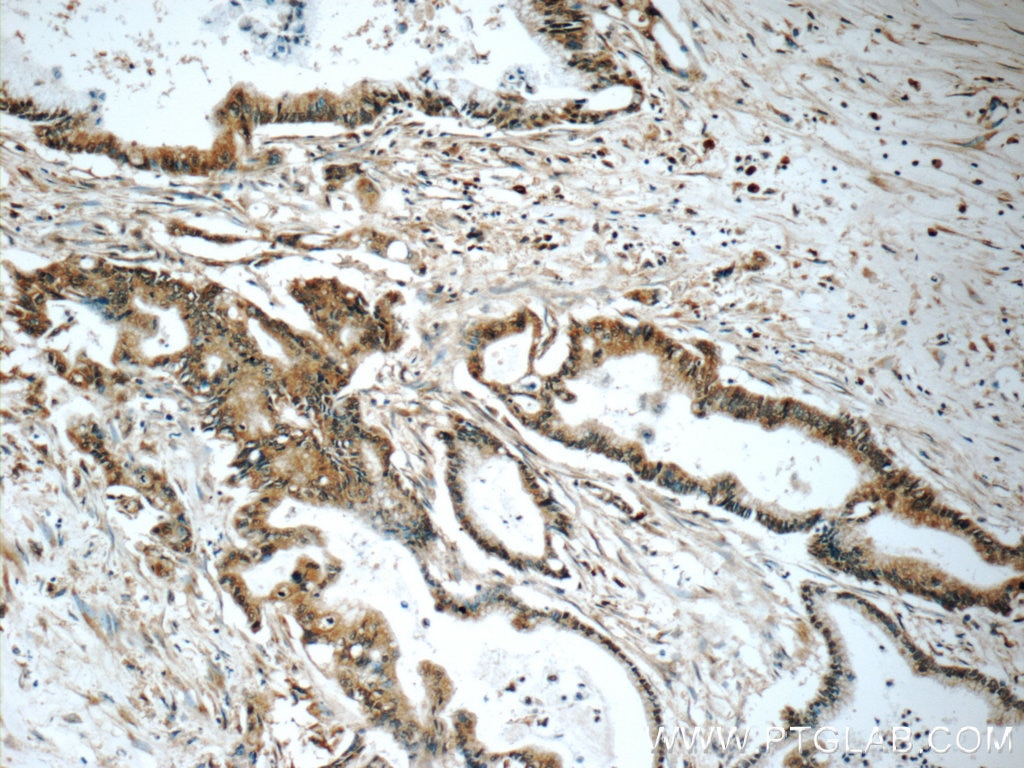 Immunohistochemistry (IHC) staining of human pancreas cancer tissue using PRDX4 Monoclonal antibody (60286-1-Ig)