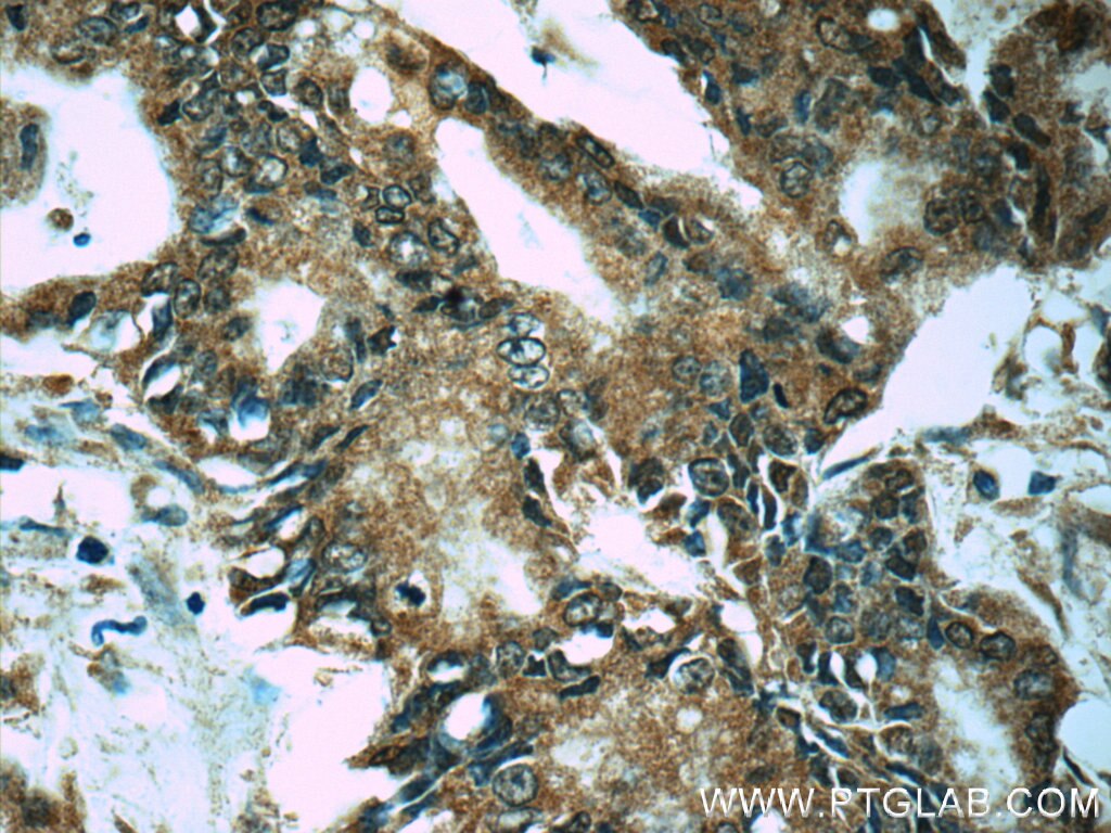Immunohistochemistry (IHC) staining of human pancreas cancer tissue using PRDX4 Monoclonal antibody (60286-1-Ig)