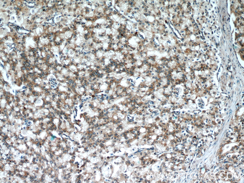 Immunohistochemistry (IHC) staining of human prostate cancer tissue using PRDX4 Monoclonal antibody (60286-1-Ig)