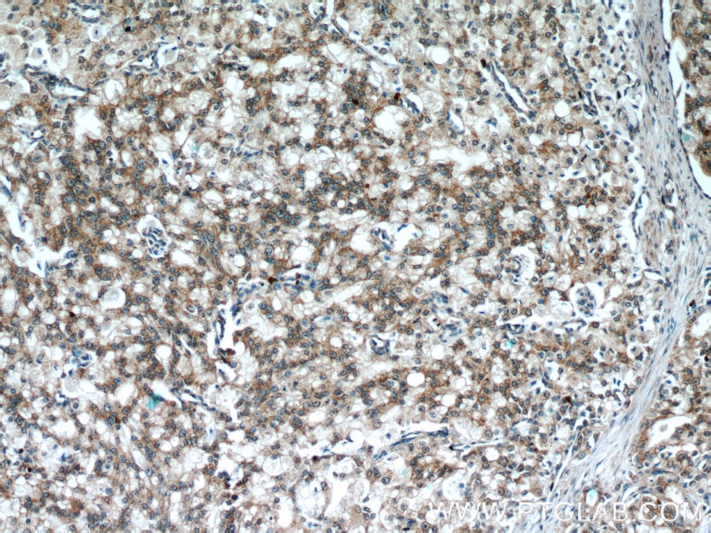 IHC staining of human prostate cancer using 60286-1-Ig