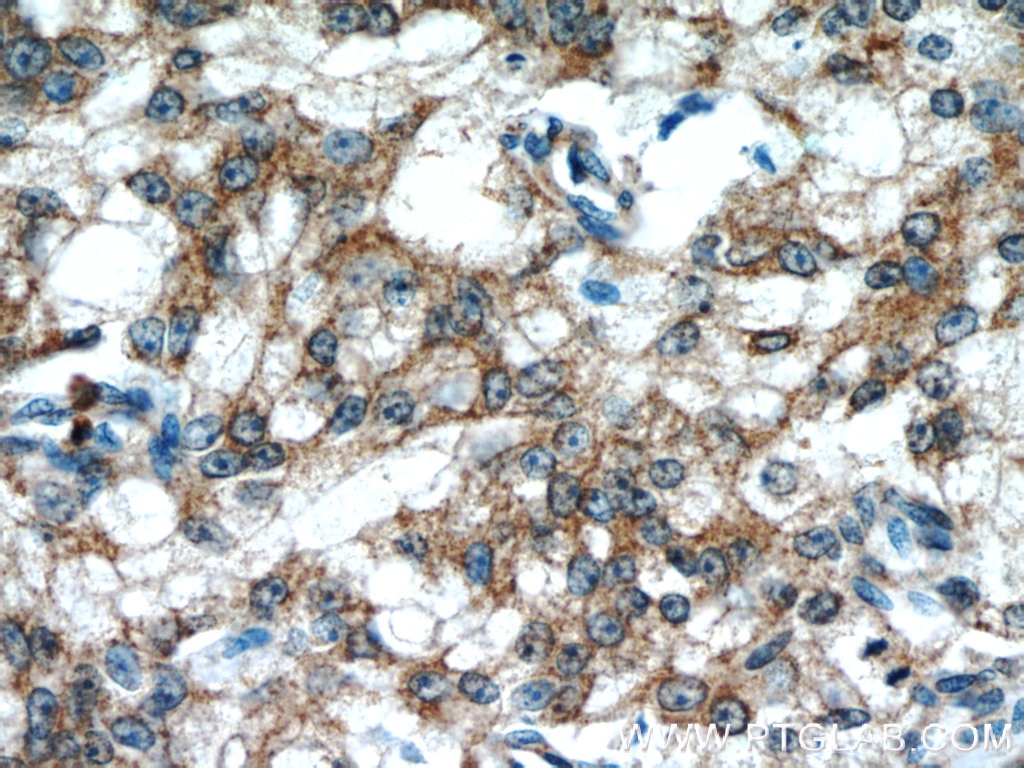 Immunohistochemistry (IHC) staining of human prostate cancer tissue using PRDX4 Monoclonal antibody (60286-1-Ig)