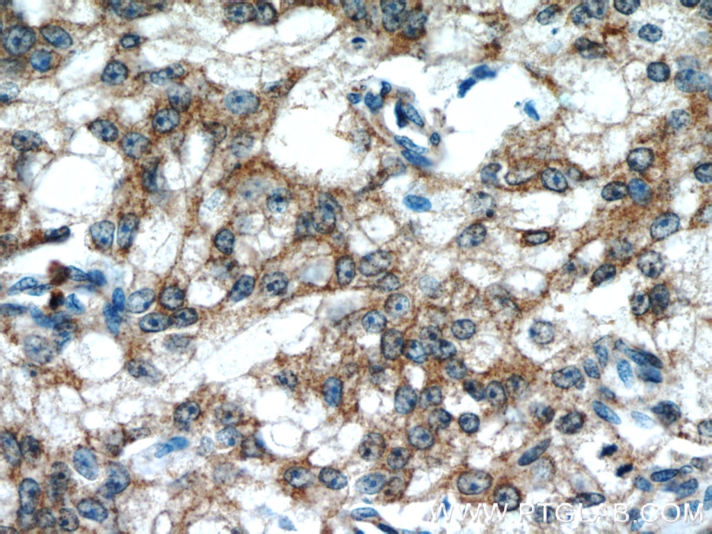 IHC staining of human prostate cancer using 60286-1-Ig