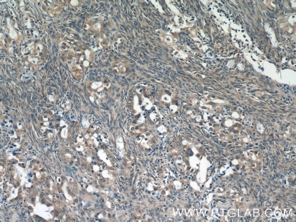 Immunohistochemistry (IHC) staining of human ovary tumor tissue using PREB Polyclonal antibody (10146-2-AP)