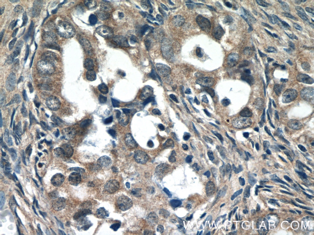 IHC staining of human ovary tumor using 10146-2-AP