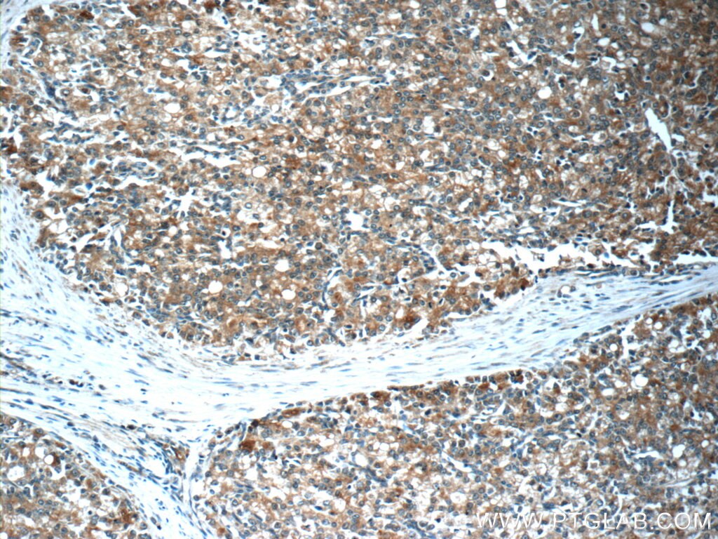 Immunohistochemistry (IHC) staining of human prostate cancer tissue using PREB Polyclonal antibody (10146-2-AP)