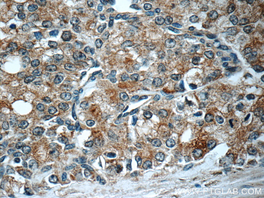 Immunohistochemistry (IHC) staining of human prostate cancer tissue using PREB Polyclonal antibody (10146-2-AP)