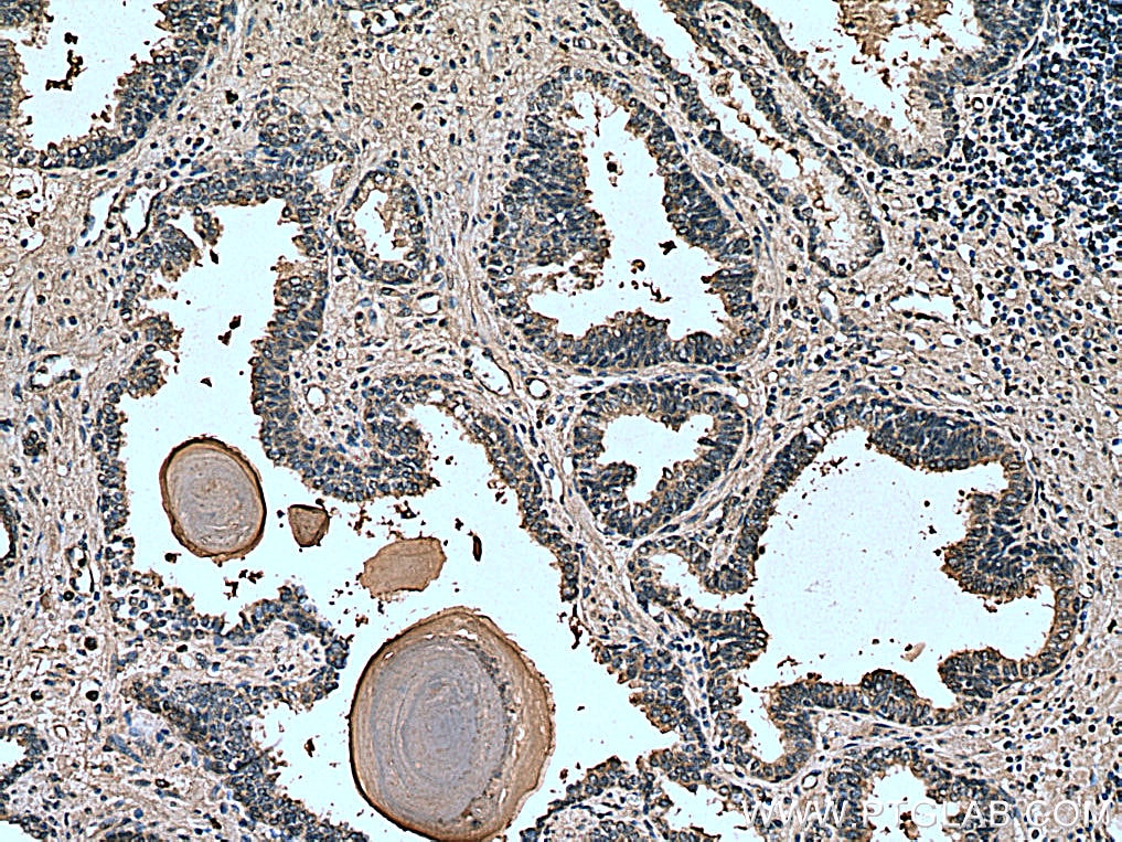 Immunohistochemistry (IHC) staining of human prostate cancer tissue using PREB Monoclonal antibody (66981-1-Ig)