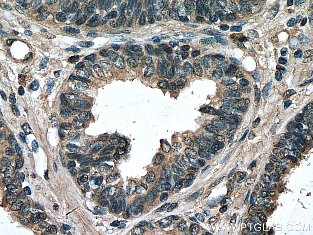 Immunohistochemistry (IHC) staining of human prostate cancer tissue using PREB Monoclonal antibody (66981-1-Ig)