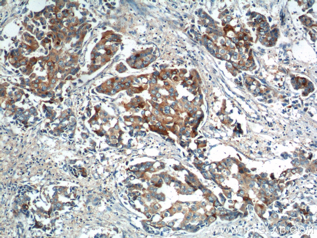 Immunohistochemistry (IHC) staining of human breast cancer tissue using PRELID1 Polyclonal antibody (10877-1-AP)