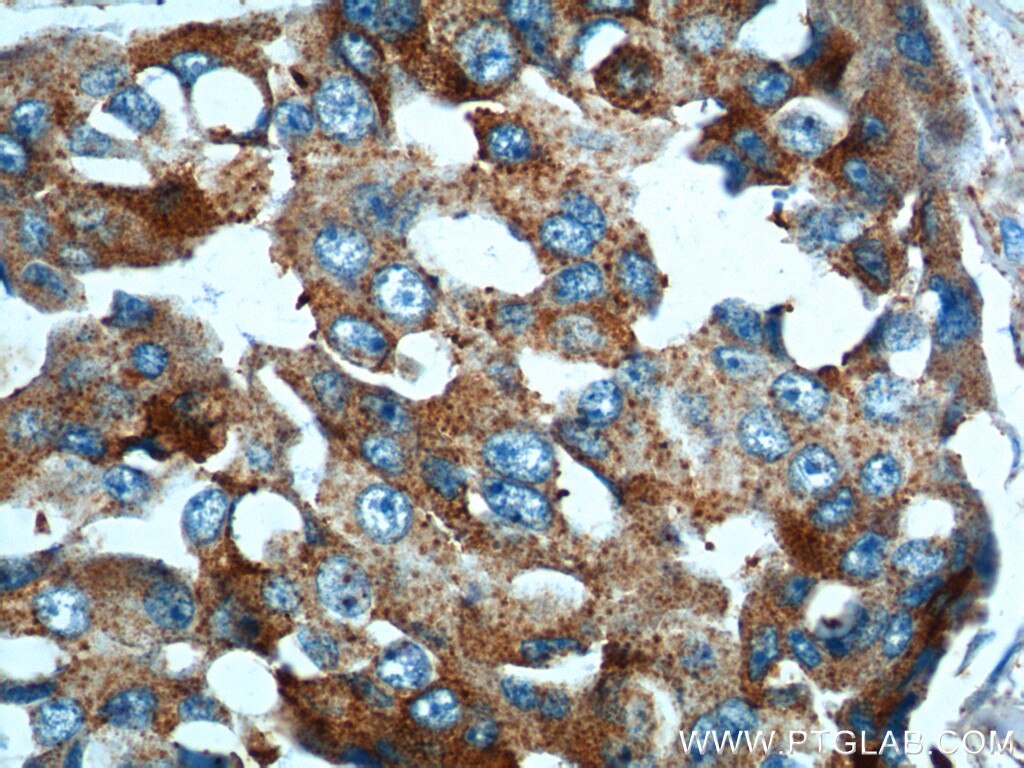 Immunohistochemistry (IHC) staining of human breast cancer tissue using PRELID1 Polyclonal antibody (10877-1-AP)