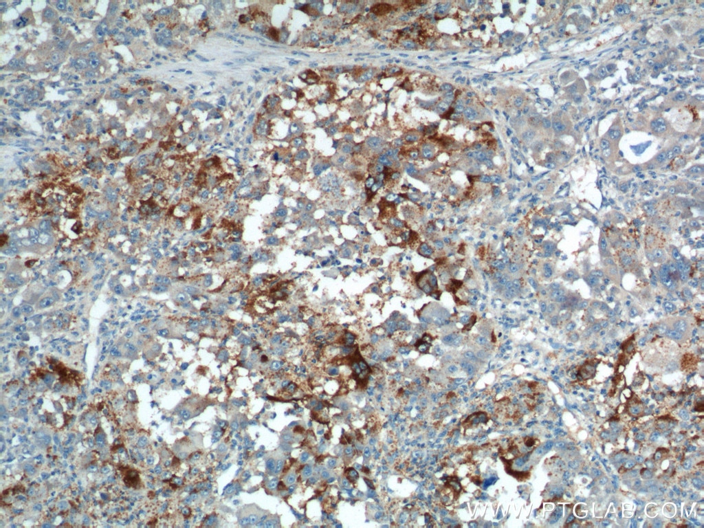 IHC staining of human liver cancer using 10877-1-AP