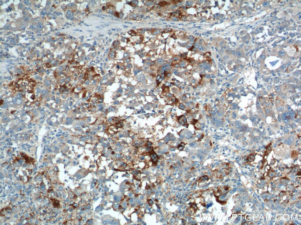 Immunohistochemistry (IHC) staining of human liver cancer tissue using PRELID1 Polyclonal antibody (10877-1-AP)