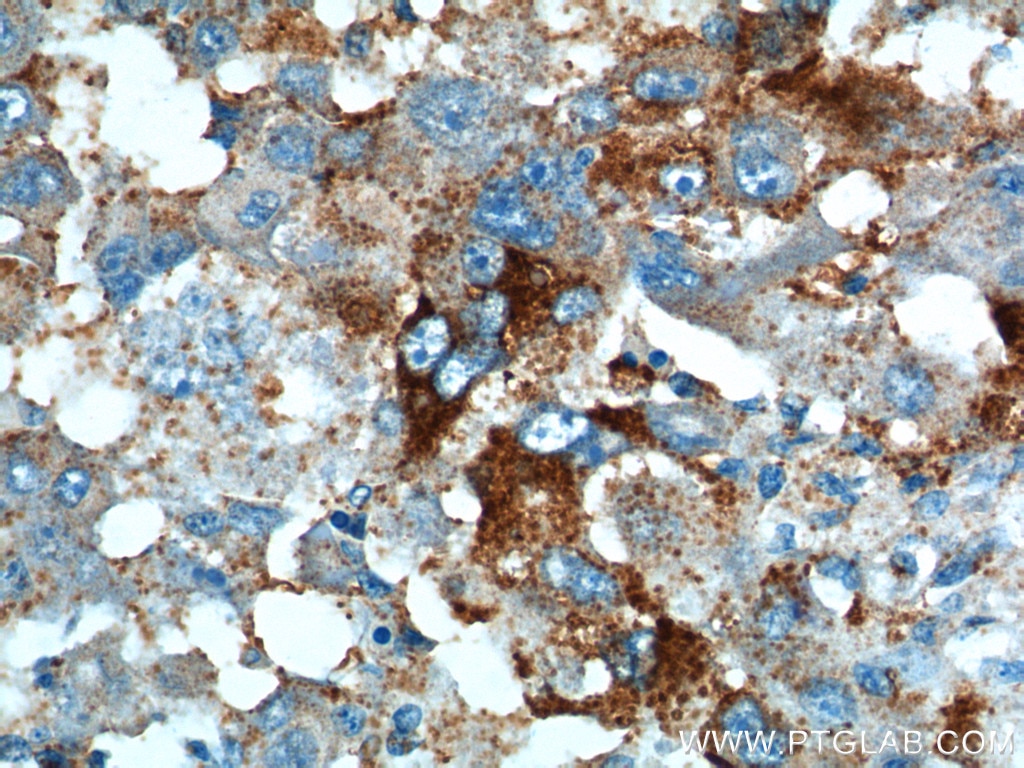 Immunohistochemistry (IHC) staining of human liver cancer tissue using PRELID1 Polyclonal antibody (10877-1-AP)