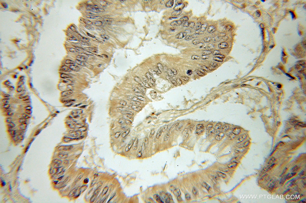 IHC staining of human colon cancer using 10877-1-AP