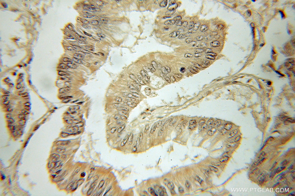 Immunohistochemistry (IHC) staining of human colon cancer tissue using PRELID1 Polyclonal antibody (10877-1-AP)