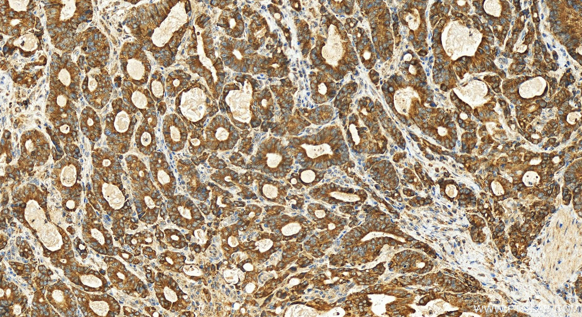 Immunohistochemistry (IHC) staining of human stomach cancer tissue using PRELP Polyclonal antibody (23783-1-AP)