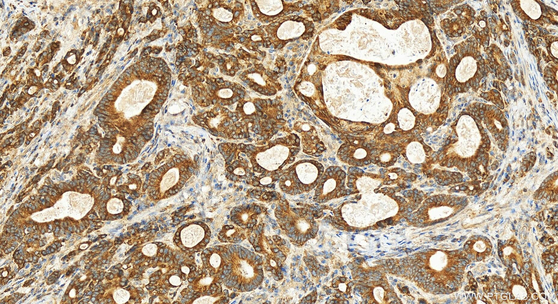 Immunohistochemistry (IHC) staining of human stomach cancer tissue using PRELP Polyclonal antibody (23783-1-AP)