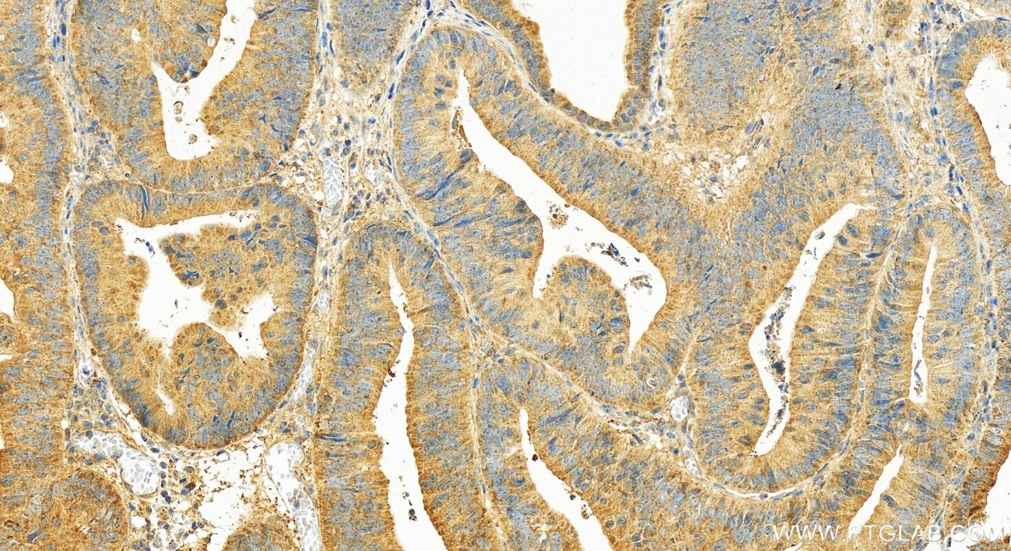 Immunohistochemistry (IHC) staining of human colon cancer tissue using PREP Polyclonal antibody (11536-1-AP)