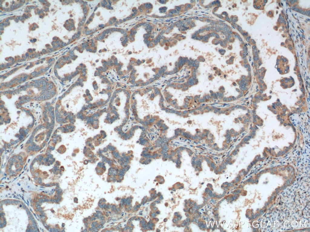 Immunohistochemistry (IHC) staining of human ovary tumor tissue using PREP Polyclonal antibody (11536-1-AP)
