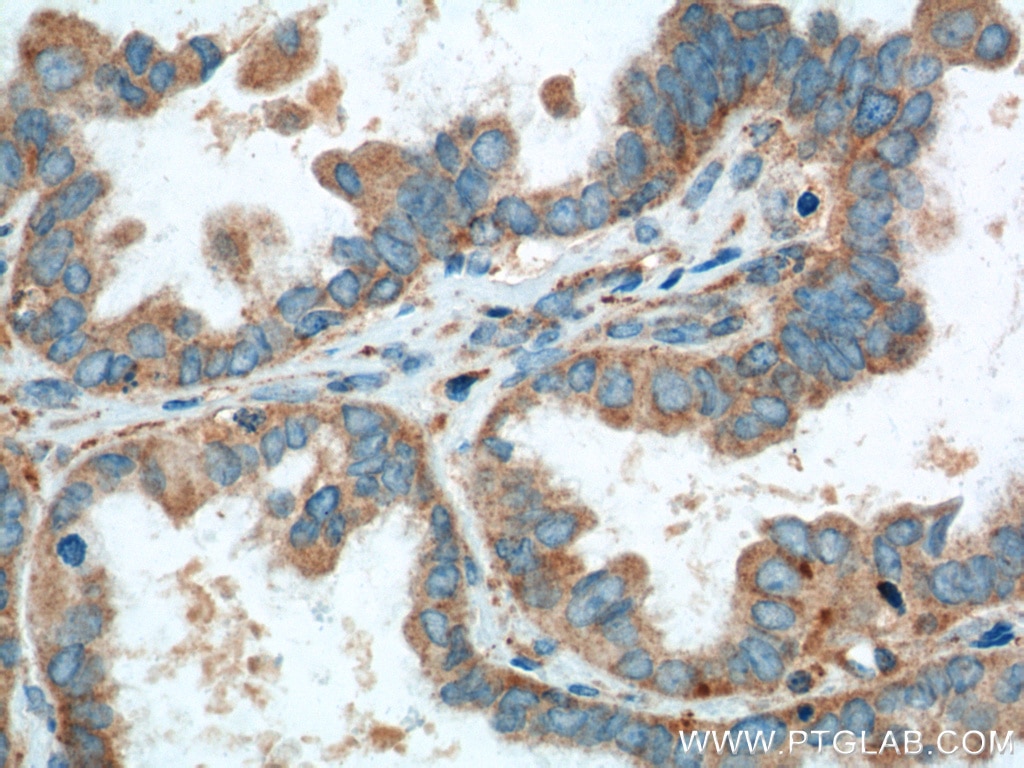 IHC staining of human ovary tumor using 11536-1-AP