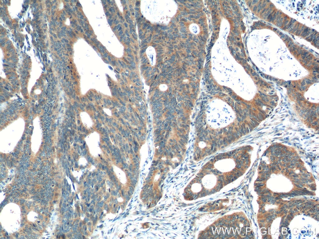 Immunohistochemistry (IHC) staining of human colon cancer tissue using PREP Polyclonal antibody (11536-1-AP)