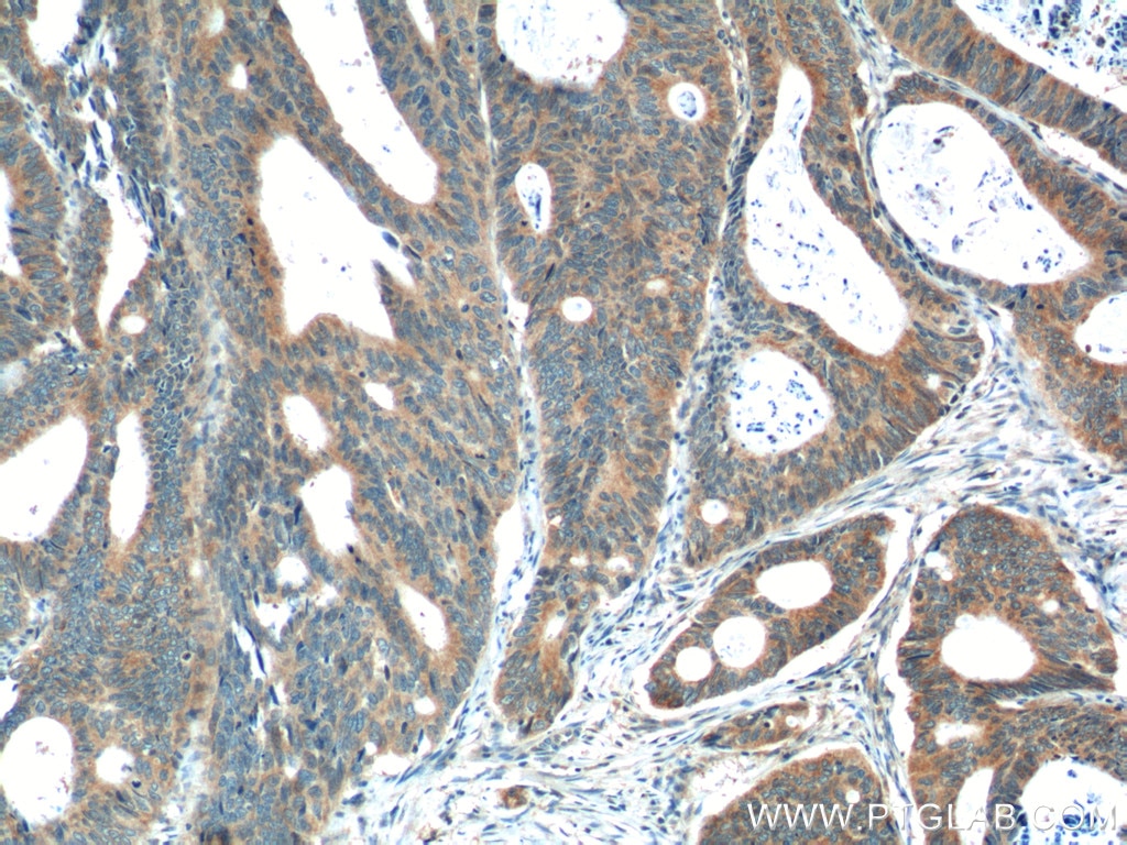 IHC staining of human colon cancer using 11536-1-AP