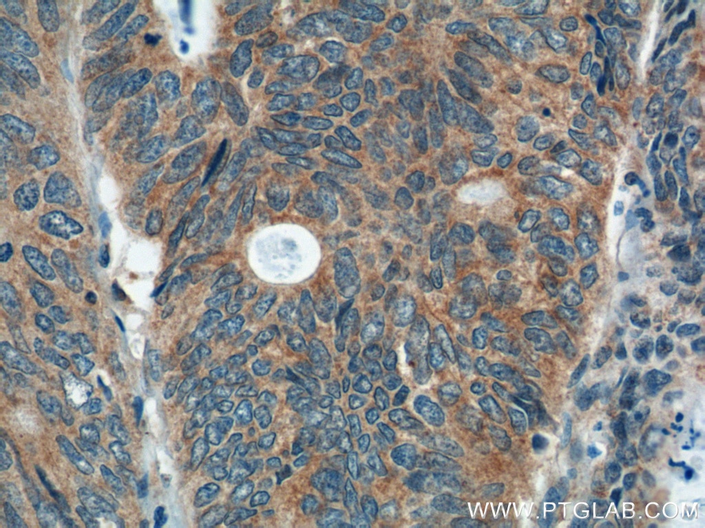 IHC staining of human colon cancer using 11536-1-AP