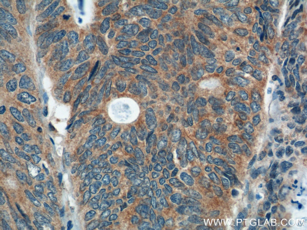 Immunohistochemistry (IHC) staining of human colon cancer tissue using PREP Polyclonal antibody (11536-1-AP)