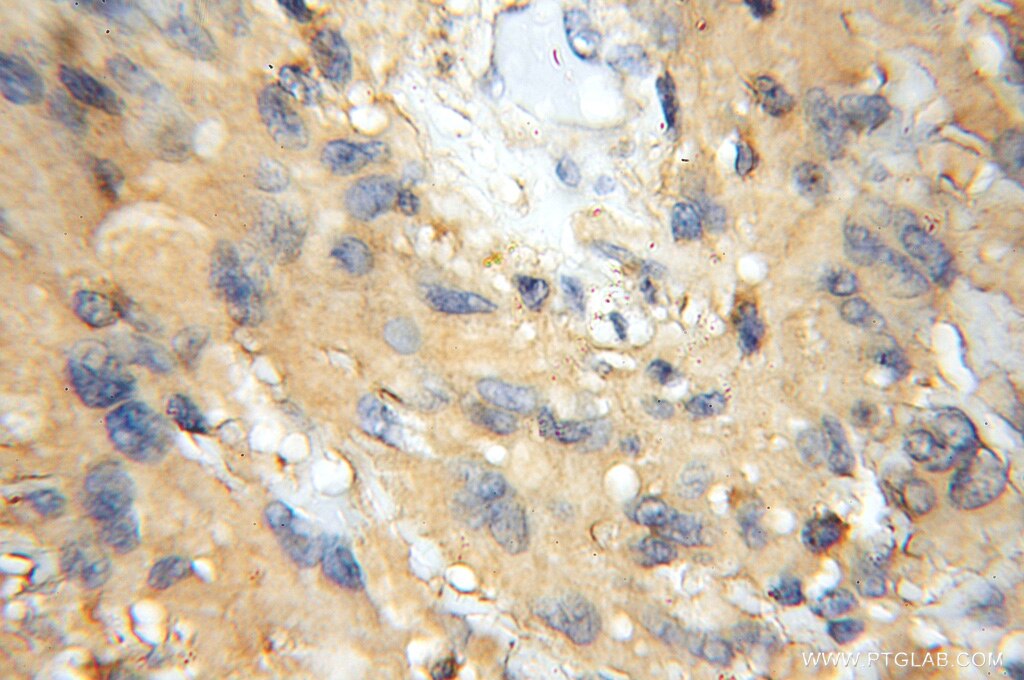 Immunohistochemistry (IHC) staining of human gliomas tissue using PREP Polyclonal antibody (11536-1-AP)