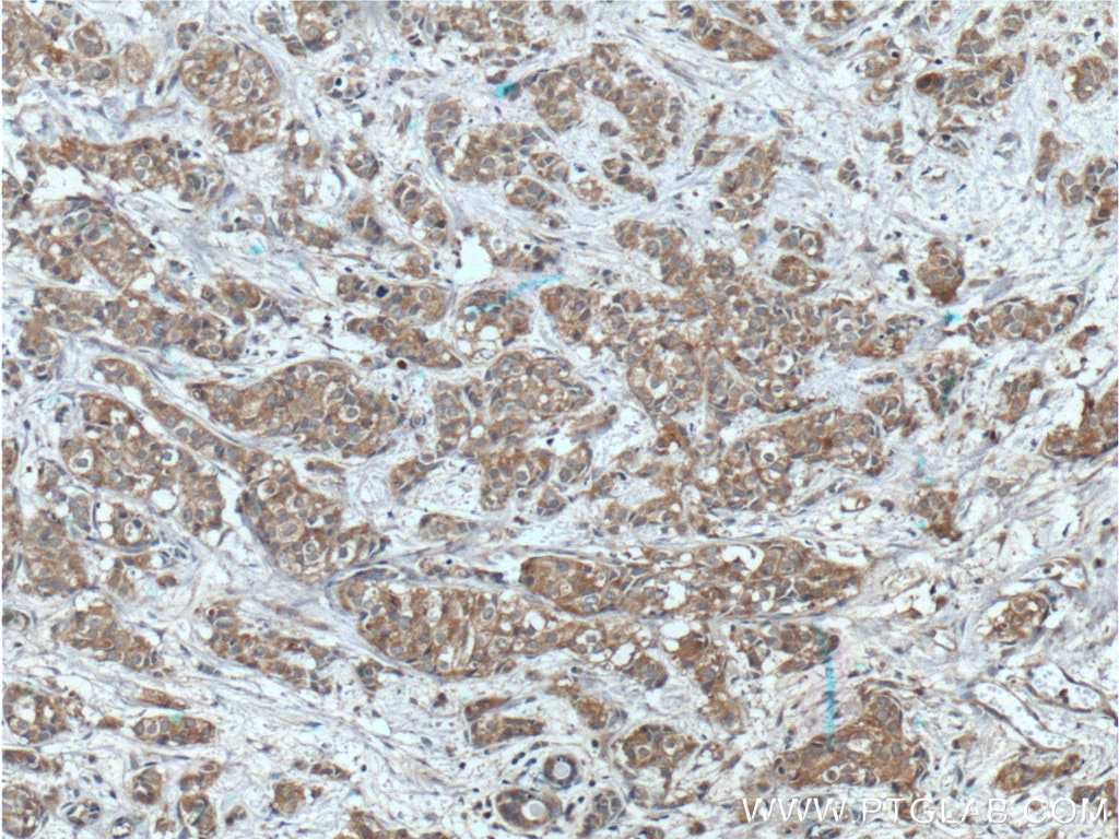 Immunohistochemistry (IHC) staining of human breast cancer tissue using PRG2 Polyclonal antibody (10766-1-AP)