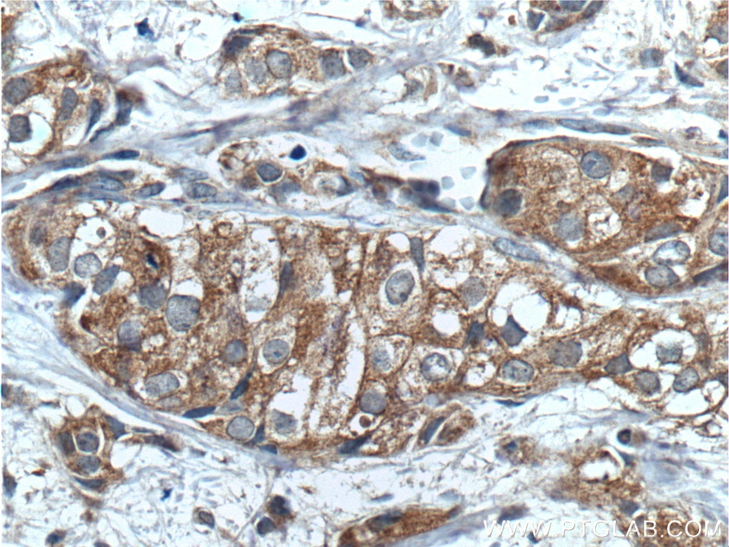 IHC staining of human breast cancer using 10766-1-AP